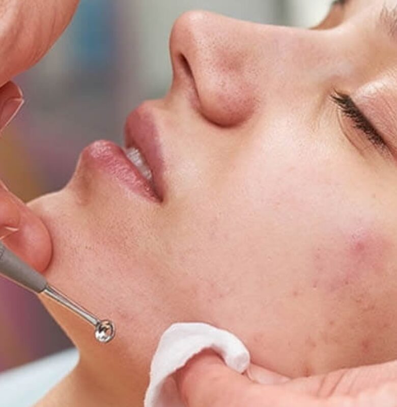 TRATAMIENTO DE ACNE: PAQUETE 4 SESIONES