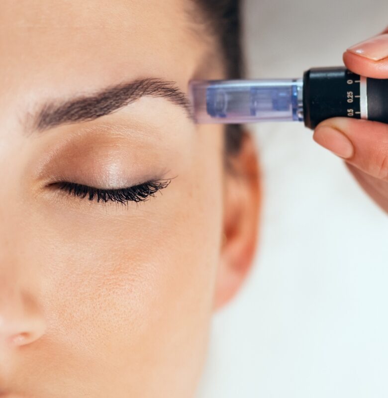 DERMAPEN: UNA SOLA SESION